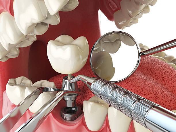 Best Emergency Root Canal Treatment in Bolivar Peninsula, TX
